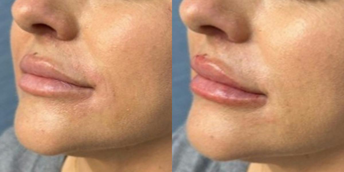Lip Filler Before & After Gallery - Patient 219464 - Image 2