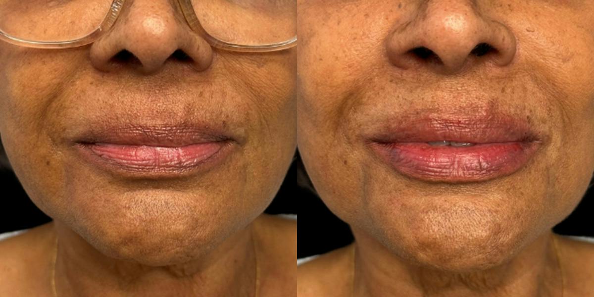Lip Filler Before & After Gallery - Patient 149238 - Image 1