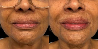 Lip Filler Before & After Gallery - Patient 149238 - Image 1