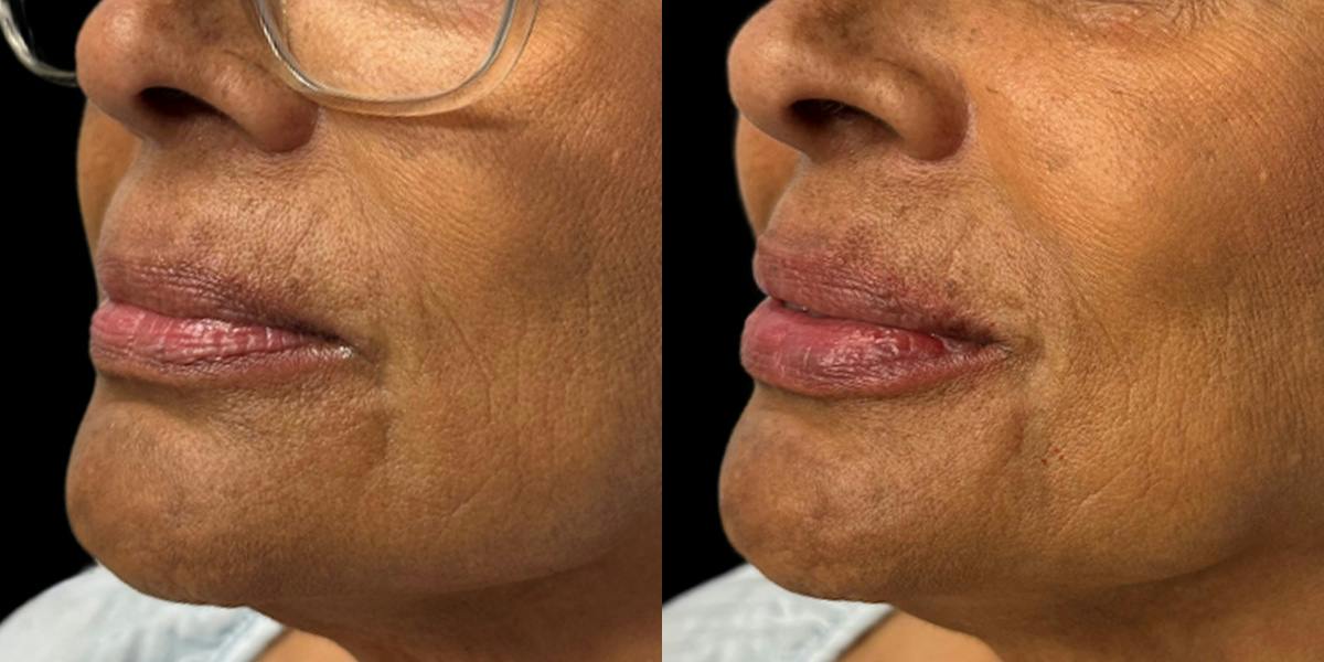 Lip Filler Before & After Gallery - Patient 149238 - Image 2