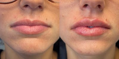 Lip Filler Before & After Gallery - Patient 262734 - Image 1