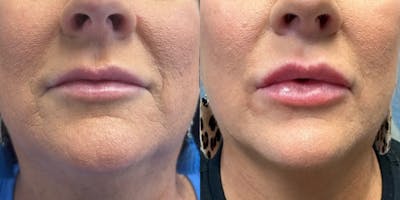 Lip Filler Before & After Gallery - Patient 244562 - Image 1