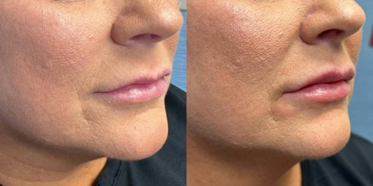 Lip Filler Before & After Gallery - Patient 244562 - Image 2