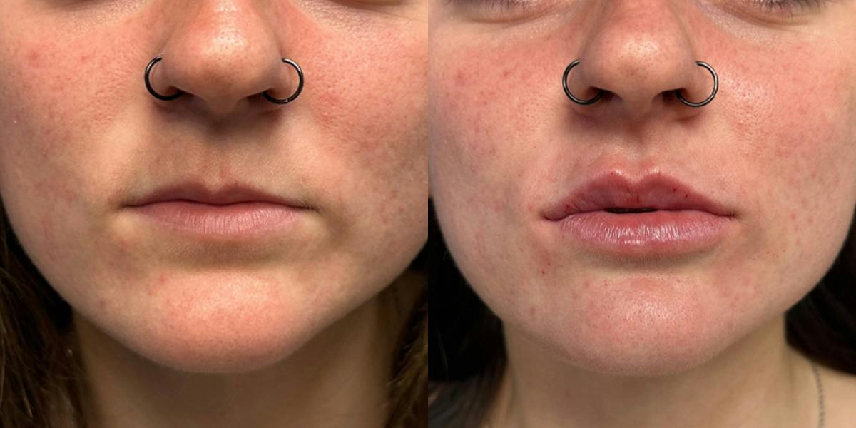 Lip Filler Before & After Gallery - Patient 313557 - Image 1