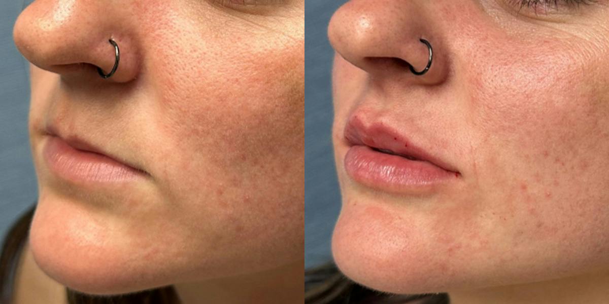 Lip Filler Before & After Gallery - Patient 313557 - Image 3