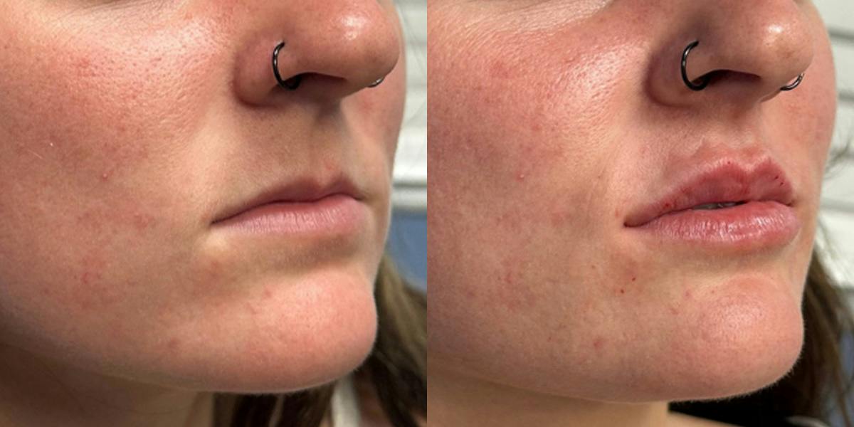 Lip Filler Before & After Gallery - Patient 313557 - Image 2