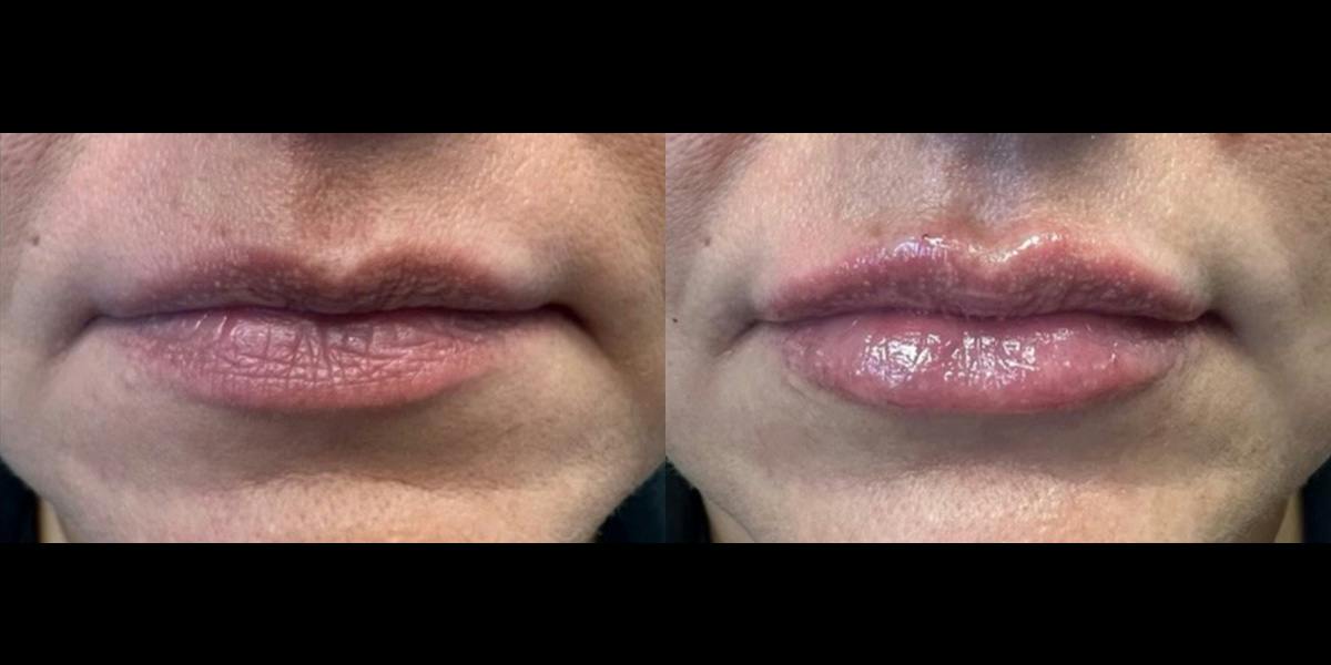 Lip Filler Before & After Gallery - Patient 366679 - Image 1