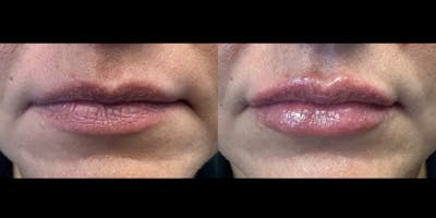 Lip Filler Before & After Gallery - Patient 366679 - Image 1