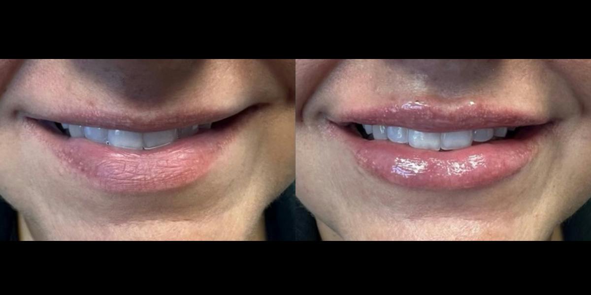 Lip Filler Before & After Gallery - Patient 366679 - Image 2