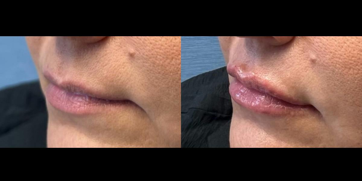 Lip Filler Before & After Gallery - Patient 366679 - Image 3