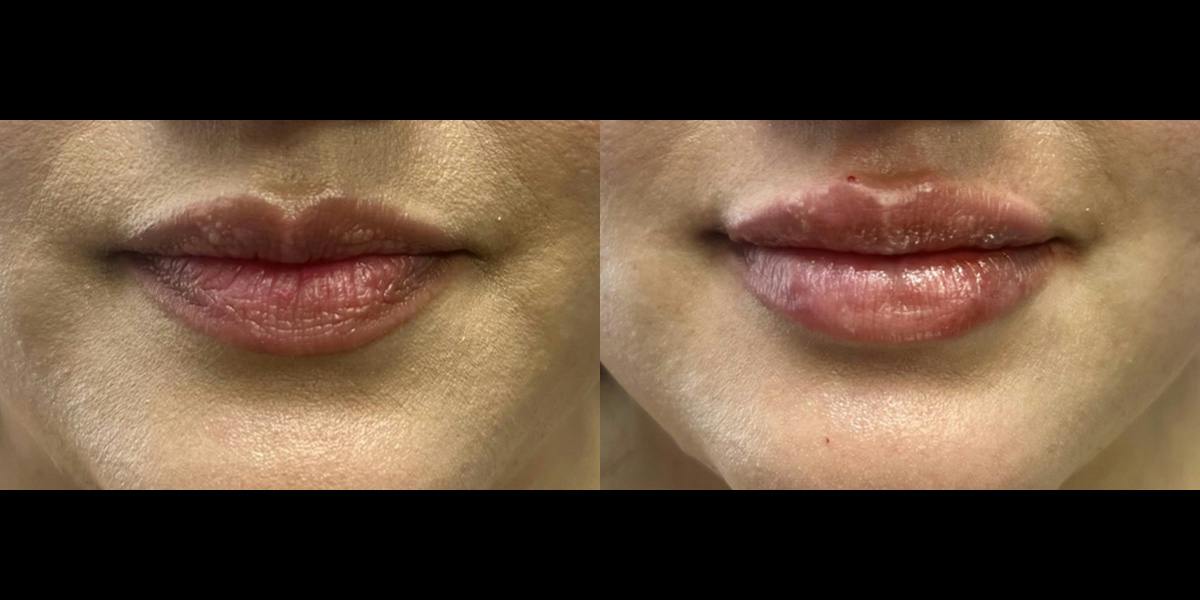 Lip Filler Before & After Gallery - Patient 155726 - Image 1