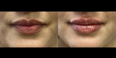 Lip Filler Before & After Gallery - Patient 155726 - Image 1