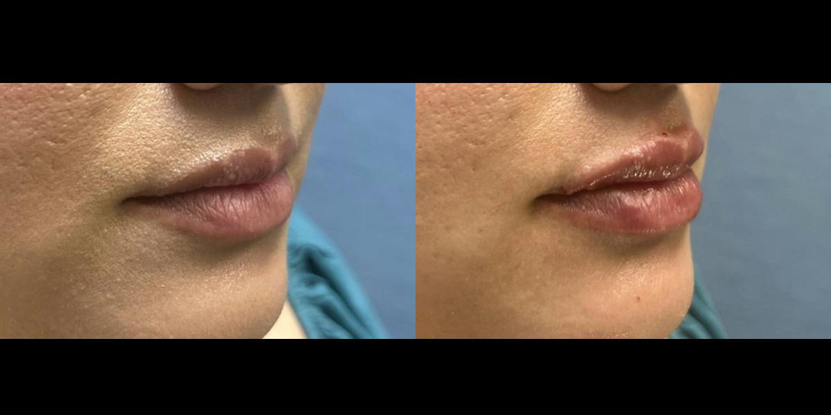 Lip Filler Before & After Gallery - Patient 155726 - Image 2