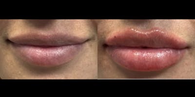 Lip Filler Before & After Gallery - Patient 136530 - Image 1