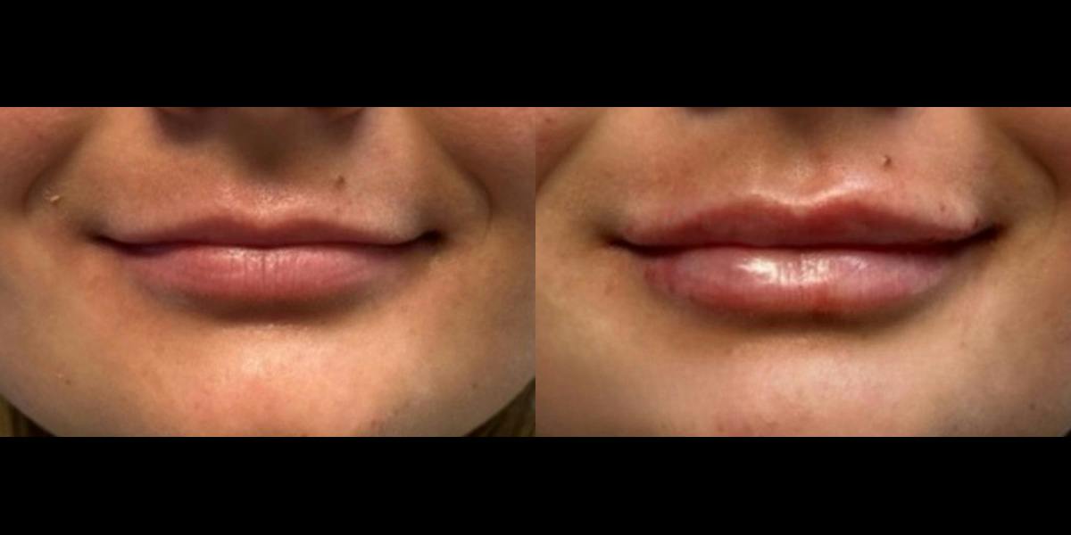 Lip Filler Before & After Gallery - Patient 395061 - Image 1