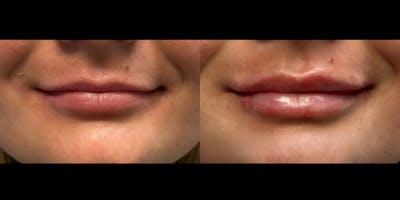 Lip Filler Before & After Gallery - Patient 395061 - Image 1
