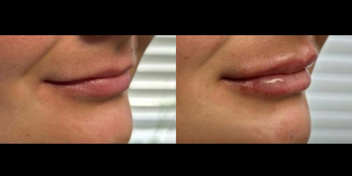 Lip Filler Before & After Gallery - Patient 395061 - Image 2