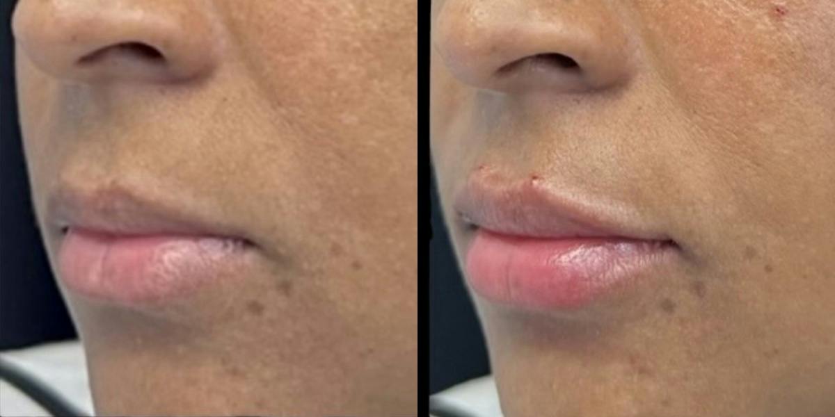 Lip Filler Before & After Gallery - Patient 839868 - Image 1