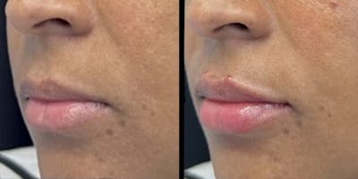 Lip Filler Before & After Gallery - Patient 839868 - Image 1