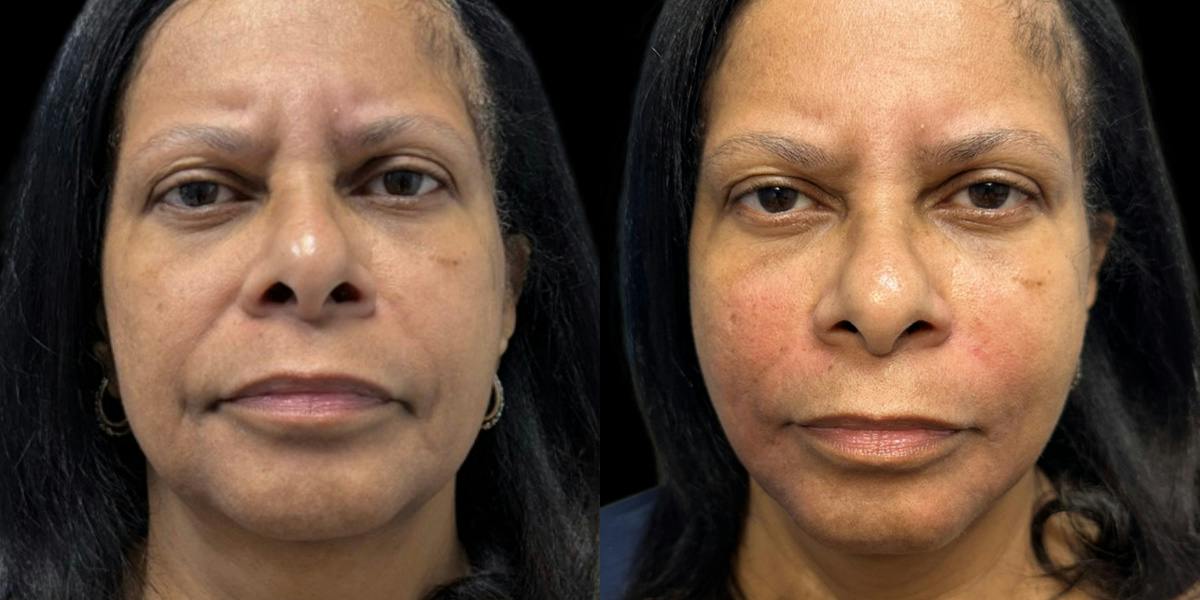 Nasolabial Fold Filler Before & After Gallery - Patient 352307 - Image 1