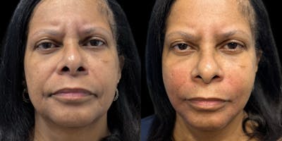 Nasolabial Fold Filler Before & After Gallery - Patient 352307 - Image 1