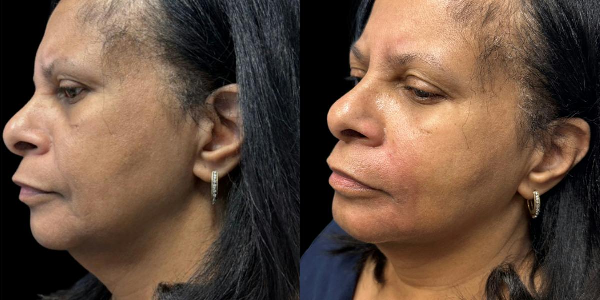 Nasolabial Fold Filler Before & After Gallery - Patient 352307 - Image 3
