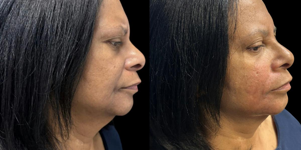 Nasolabial Fold Filler Before & After Gallery - Patient 352307 - Image 2