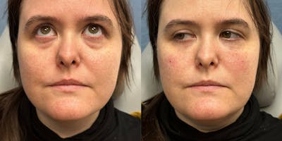 Tear Trough Filler Before & After Gallery - Patient 229805 - Image 1