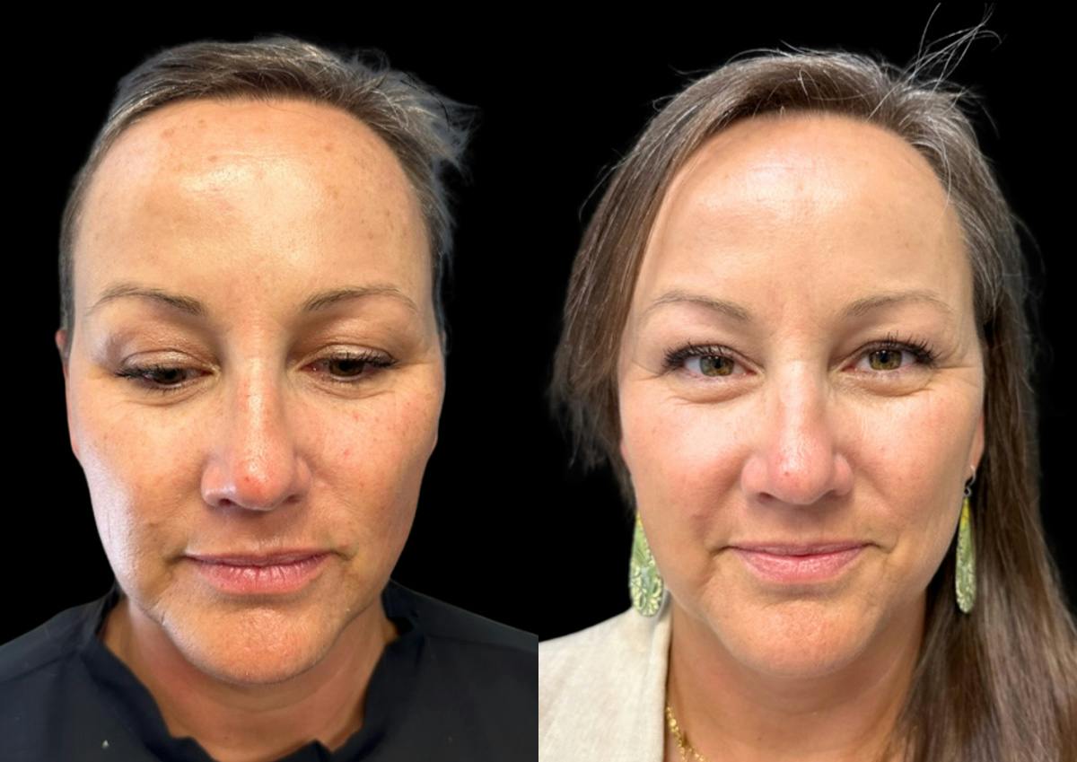 Laser Skin Rejuvenation  Before & After Gallery - Patient 189200 - Image 1