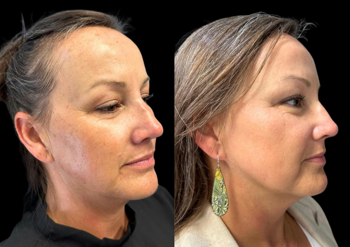 Laser Skin Rejuvenation  Before & After Gallery - Patient 189200 - Image 2
