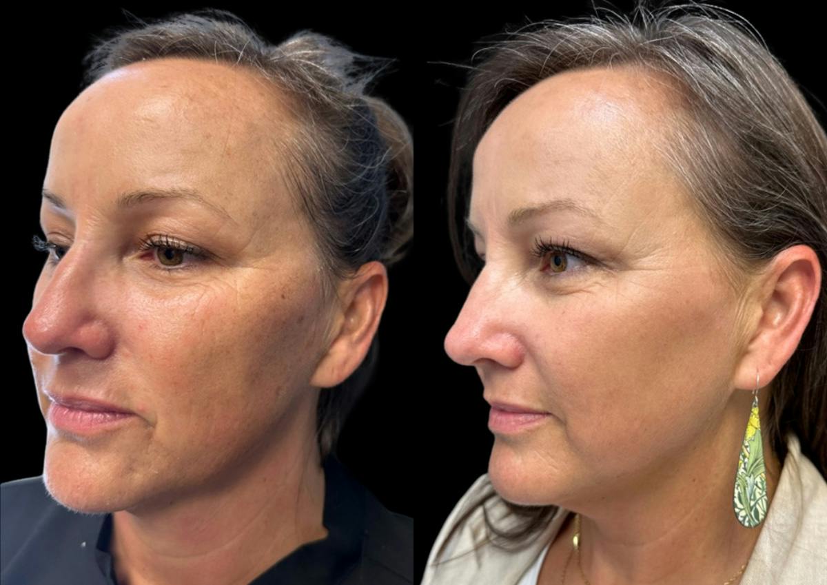 Laser Skin Rejuvenation  Before & After Gallery - Patient 189200 - Image 3