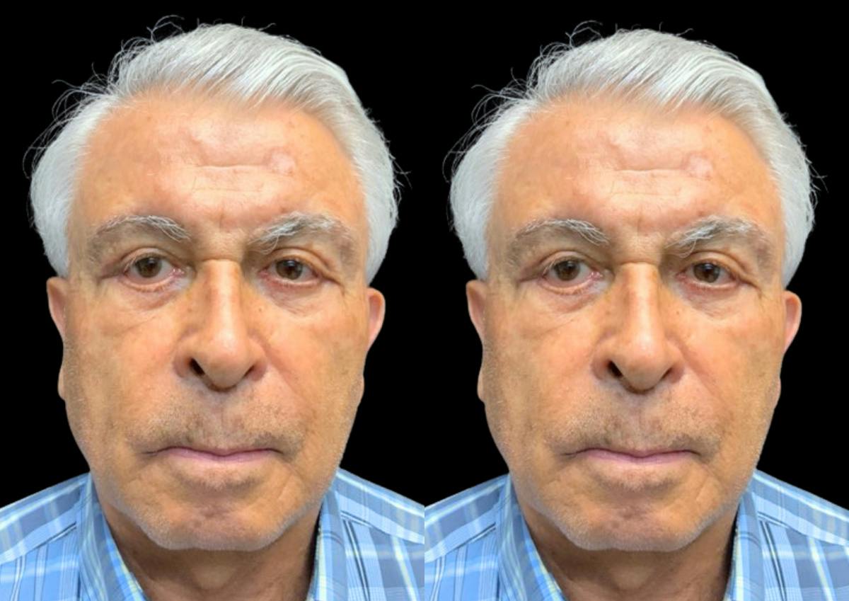 Laser Skin Rejuvenation  Before & After Gallery - Patient 460142 - Image 1