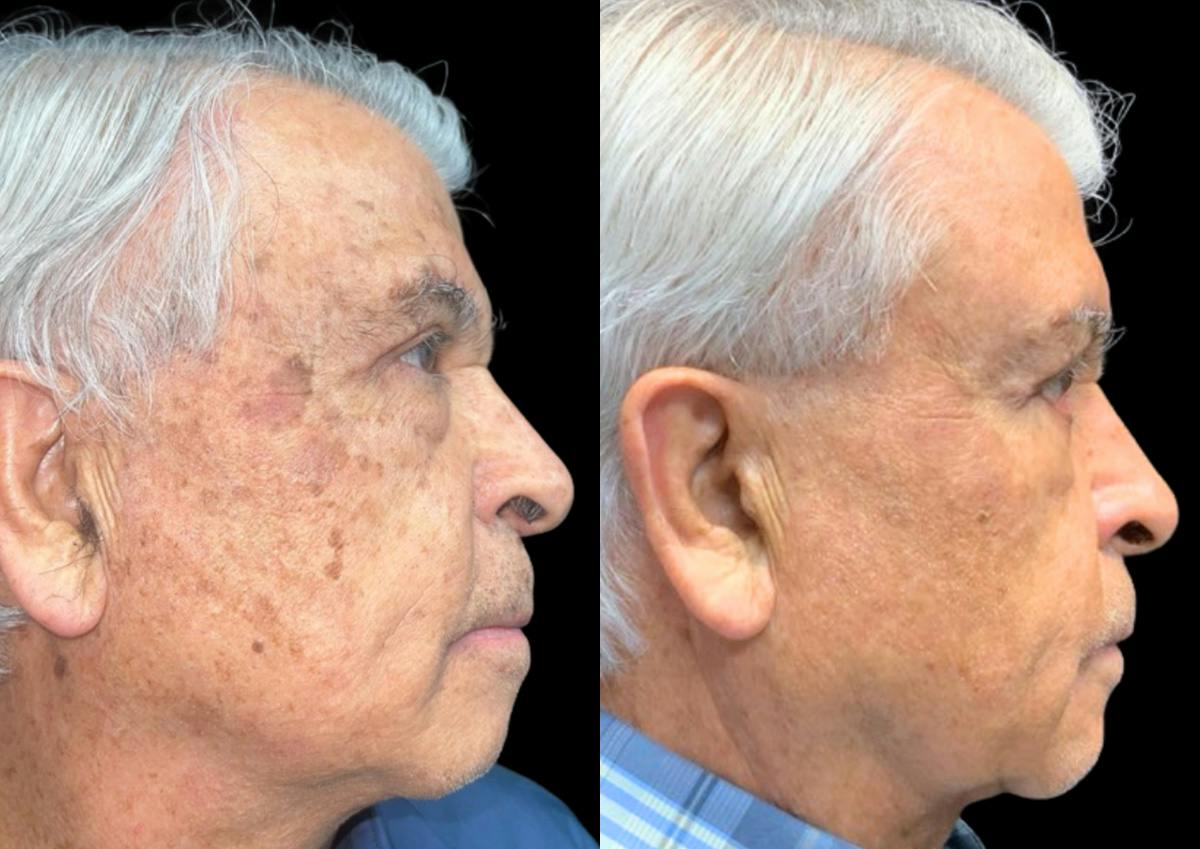 Laser Skin Rejuvenation  Before & After Gallery - Patient 460142 - Image 2
