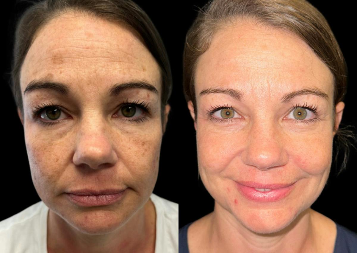 Laser Skin Rejuvenation  Before & After Gallery - Patient 645086 - Image 1
