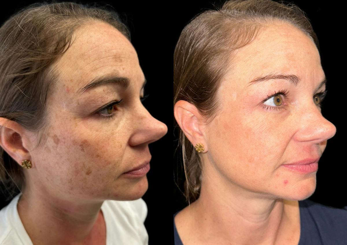Laser Skin Rejuvenation  Before & After Gallery - Patient 645086 - Image 2