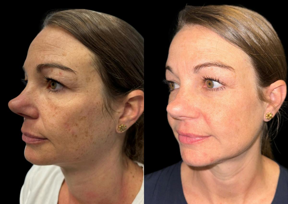 Laser Skin Rejuvenation  Before & After Gallery - Patient 645086 - Image 3