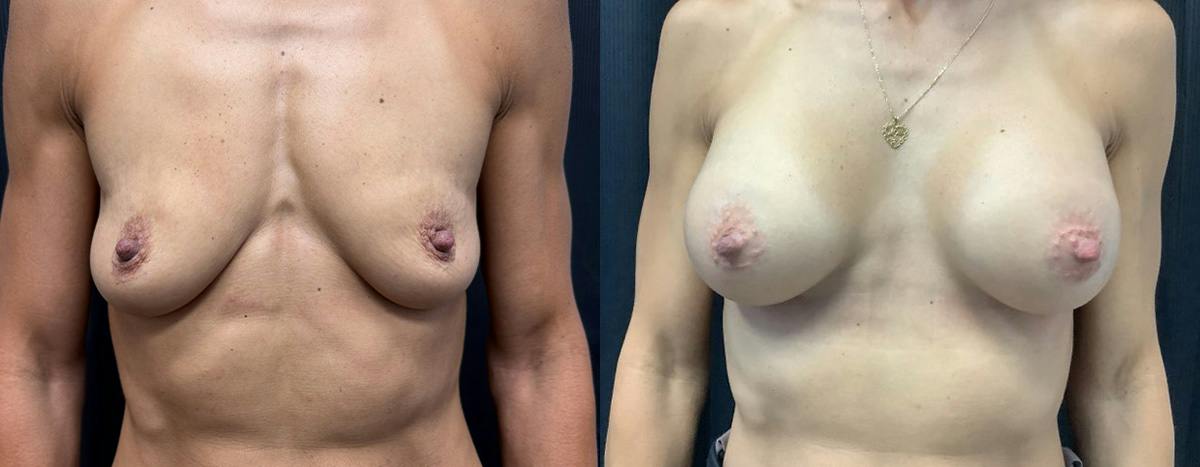 Breast Augmentation Before & After Gallery - Patient 257730 - Image 1