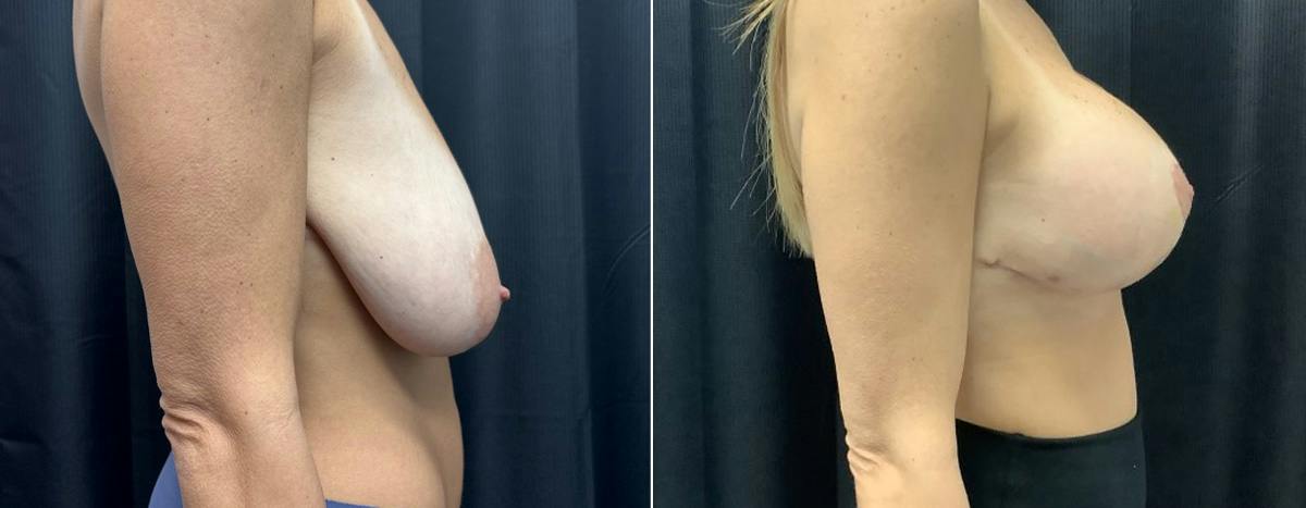Breast Augmentation with Lift Before & After Gallery - Patient 329979 - Image 2