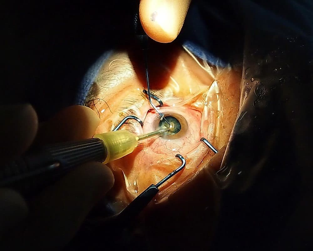 eyeball during surgery