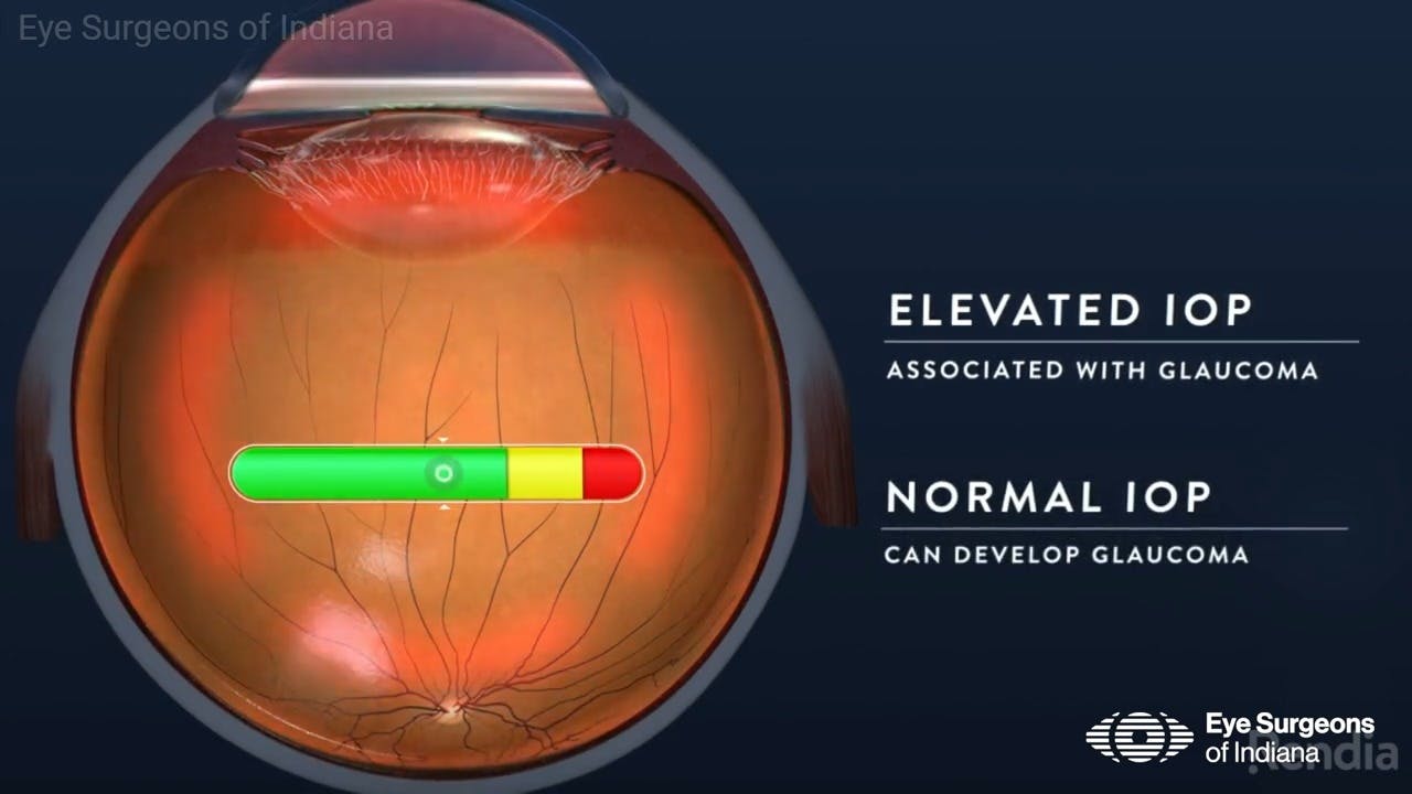 Eye Surgeons of Indiana