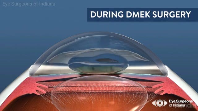 Eye Surgeons of Indiana