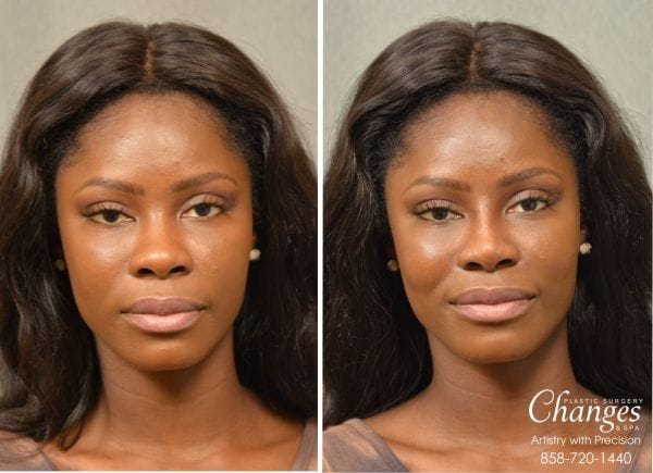 Before and after Liquid Rhinoplasty