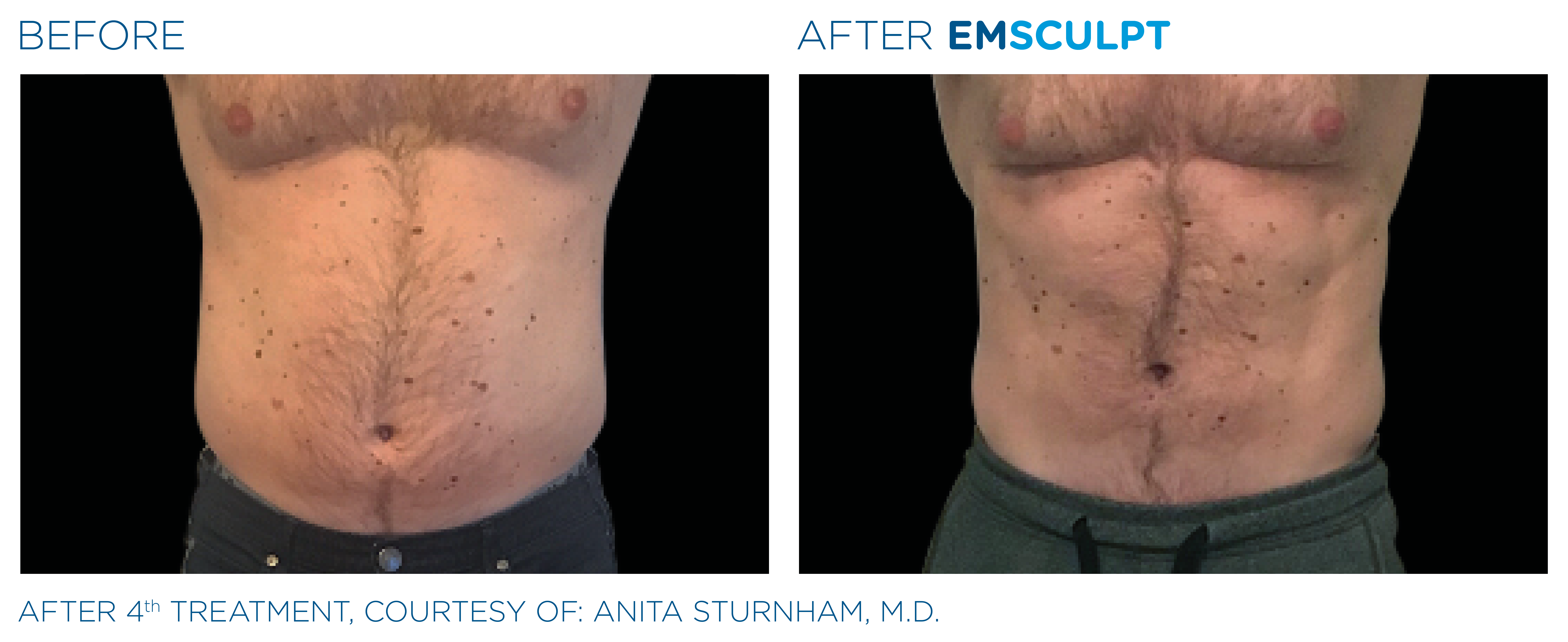 Before and after EMSCULPT