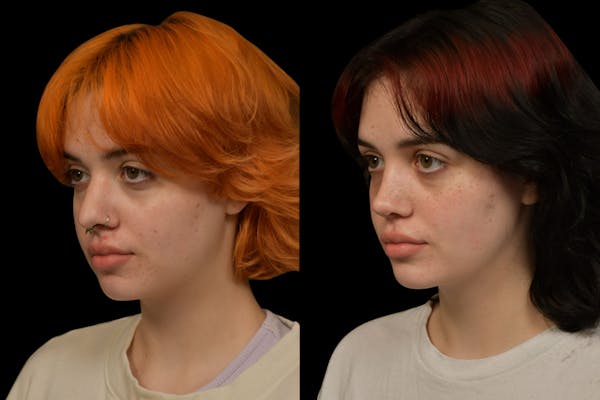 Rhinoplasty Before & After Gallery - Patient 205768 - Image 1