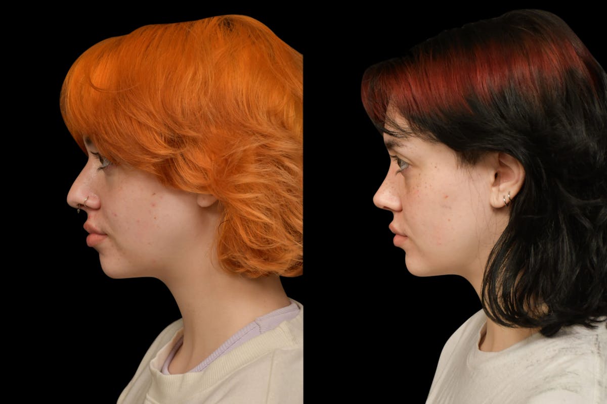 Rhinoplasty Before & After Gallery - Patient 205768 - Image 2