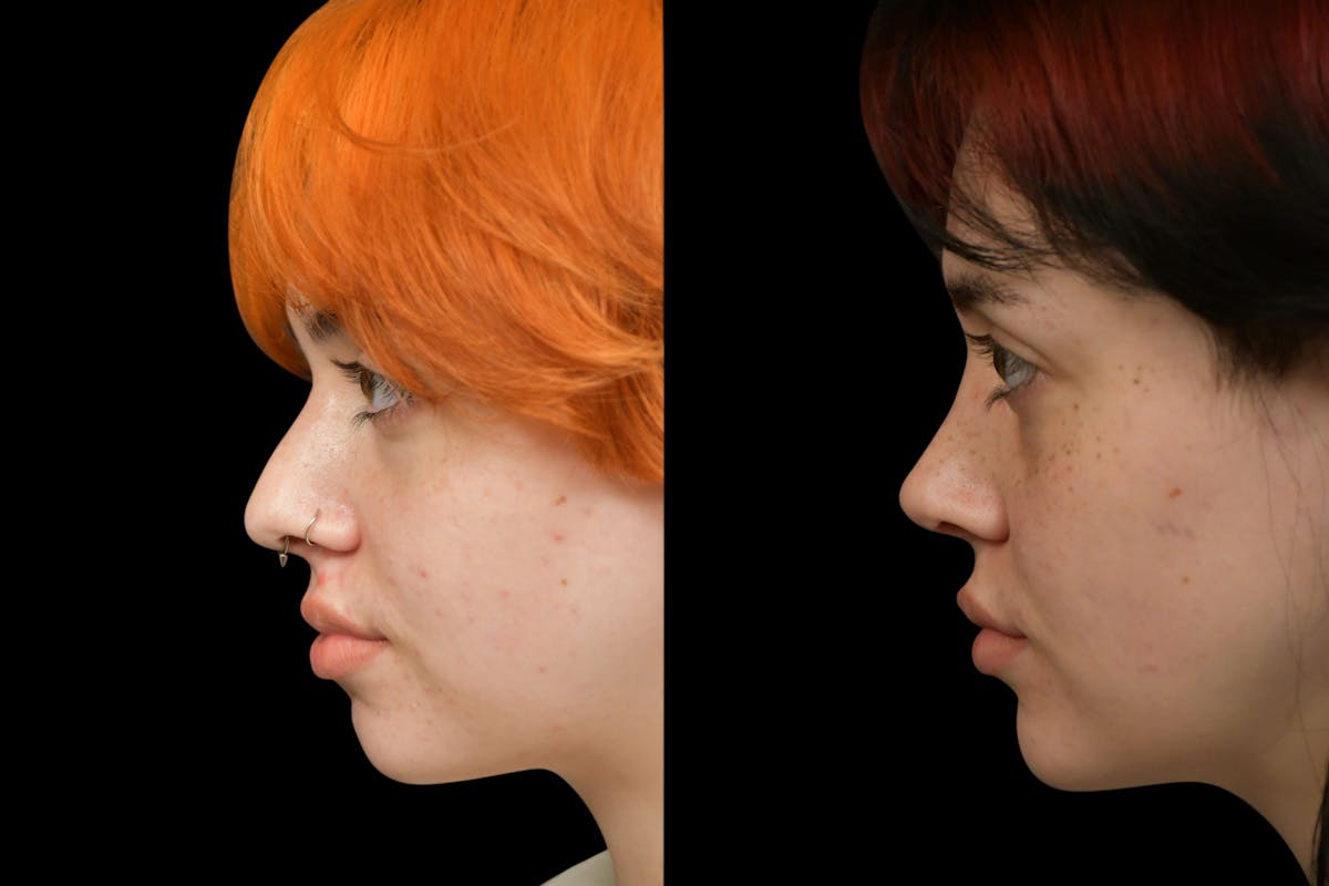Rhinoplasty Before & After Gallery - Patient 205768 - Image 5