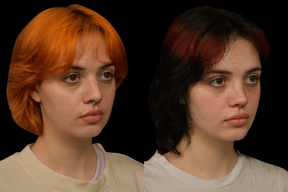 Rhinoplasty Before & After Gallery - Patient 205768 - Image 3