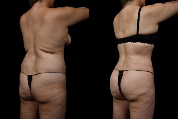 Butt Augmentation Before & After Gallery - Patient 267985 - Image 1