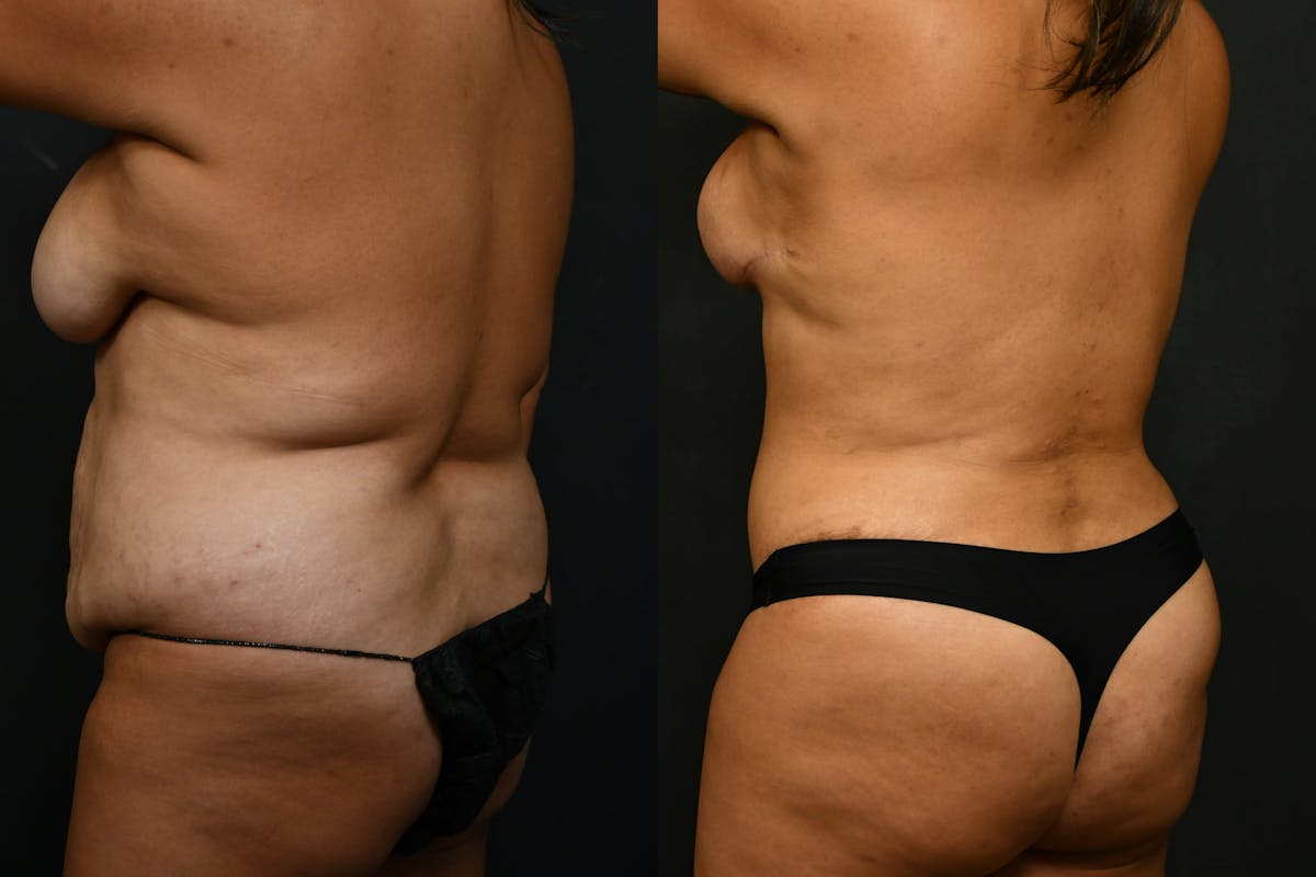 Butt Augmentation Before & After Gallery - Patient 206344 - Image 2