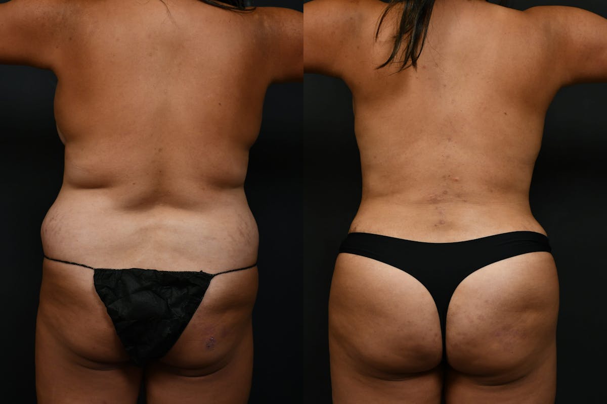 Butt Augmentation Before & After Gallery - Patient 206344 - Image 3